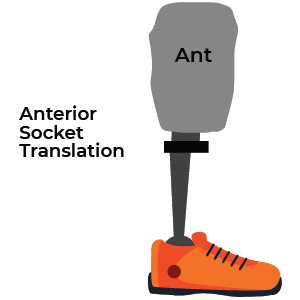 Anterior Translation Transtibial Prosthetic alignment