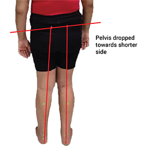 Leg length discrepancy