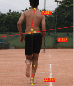 runnning biomechanics : Excessive Pronation