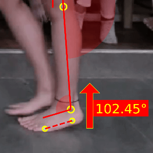Gait analysis checlist_Early heel rise