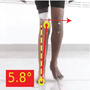 Medial thrust of Prostheses prosthetic gait