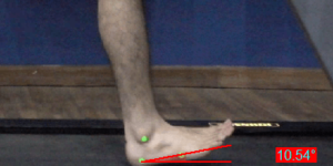 Achilles Tendinopathy_Foot Inclination Angle