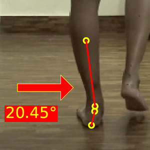 Gait analysis checlist_FLAT FOOT