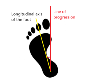 Foot Progression Angle