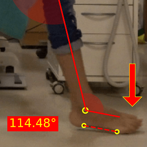 Gait analysis checlist_Foot drop
