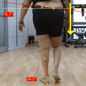 Gait retraining_Hip abductors