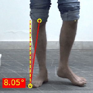 Gait retraining_Tibial rotation