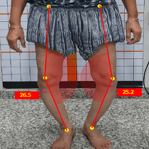 Bow leg appearance in medial knee OA