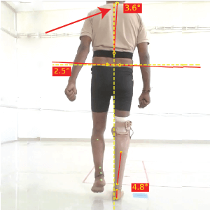 Lateral Trunk Bending prosthetic gait