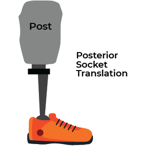 Posterior Translation Transtibial Prosthetic alignment