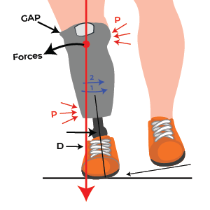 Socket Abduction Transtibial Prosthetic alignment