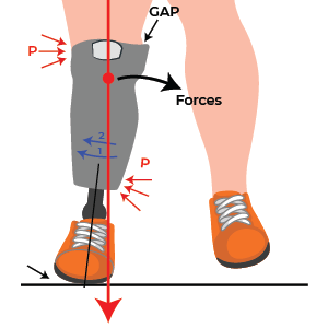 Socket Adduction Transtibial Prosthetic alignment