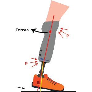 Socket Extension Transtibial Prosthetic alignment