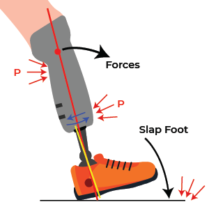Socket Flexion Transtibial Prosthetic alignment