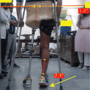 Vaulting prosthetic gait