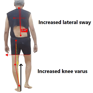 gait retraining_KNEE ADDUCTION MOMENT