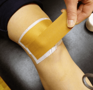 mcconell_taping_Patellofemoral Pain in Runners
