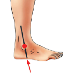 plantar flexed foot Strike pattern