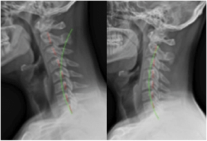 cervical lordosis posture and neutral-looking cervical spine
